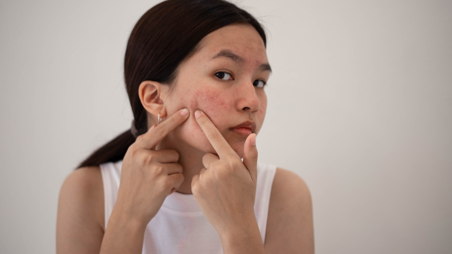 How to prevent and treat acne: A handy manual for Filipinas